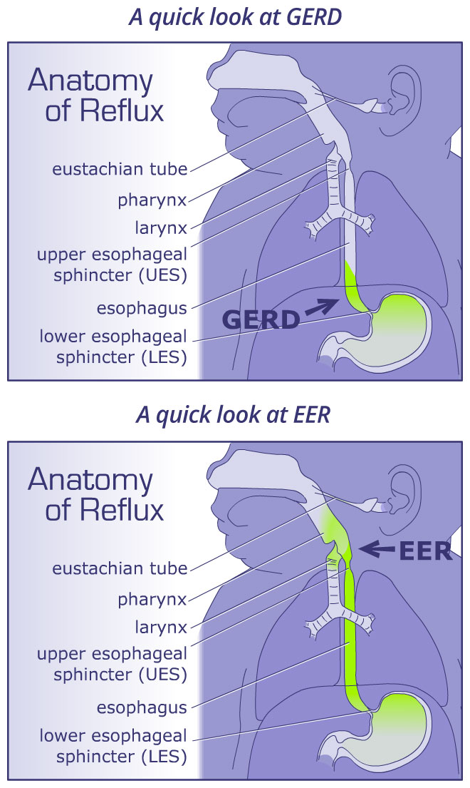 anatomy of acid reflux in infants